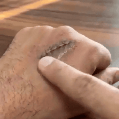 Scar Removal Cream | Keloid & Stretch Mark Care | Softening & Flattening